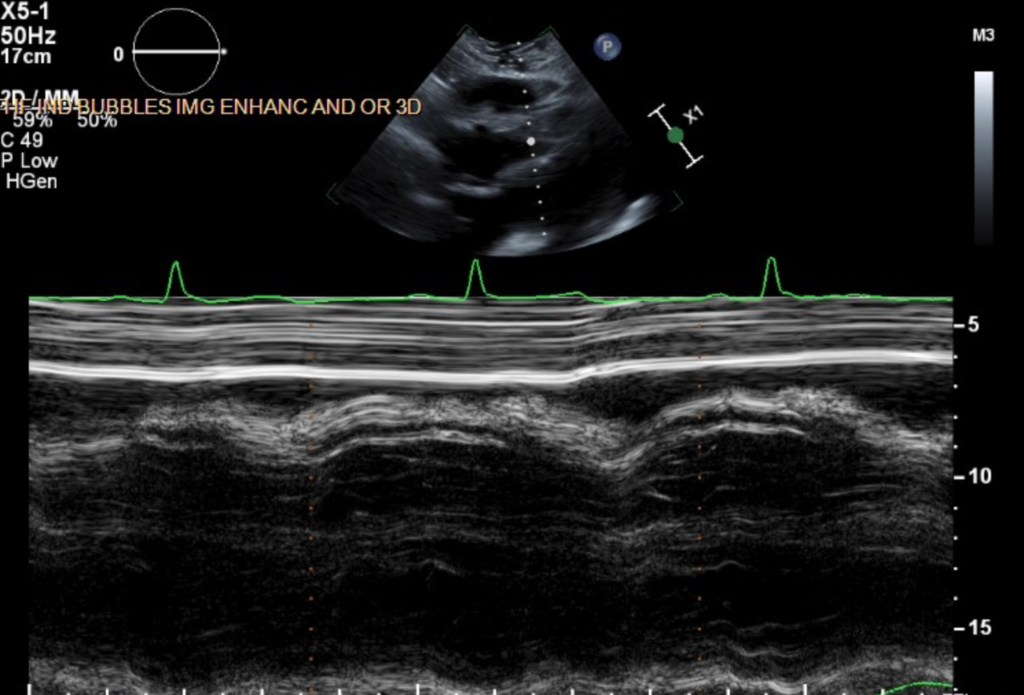 RV Diastolic Collapse in M-Mode
