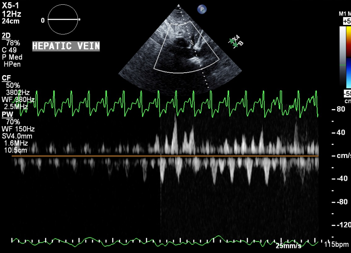 Hepatic Vein Flow Reversal Tamponade Toolbox