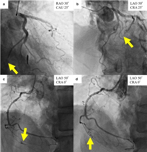Coronary Artery Laceration
