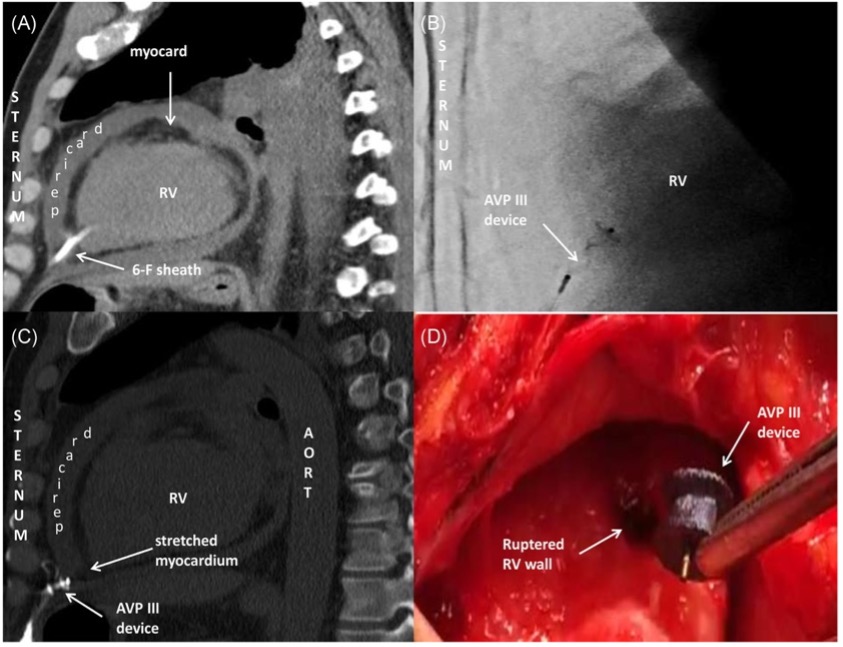RV perforation